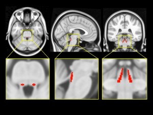 An example of the LC template (2SD) overlaid on the MNI152 brain using MRIcron.